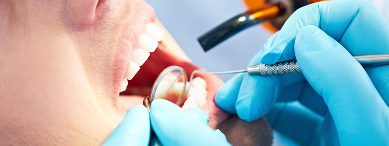 Plombage dentaire - Docteurs en Bretagne